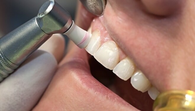۵ مزیت تمیزی عمیق دندان | عقب نشینی لثه‌ها را جدی بگیرید