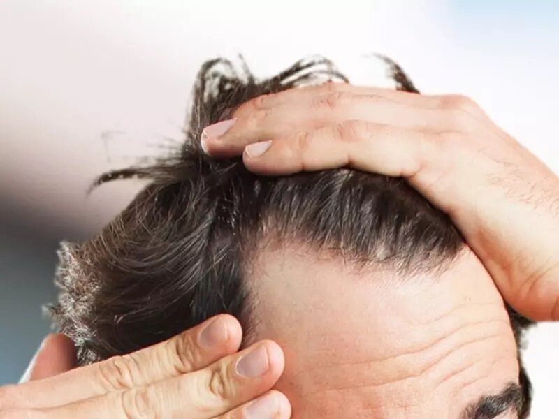 چطور از موخوره پیشگیری کنیم؟ | راز موهای درخشنده و با طراوت با این چند روش ساده موخوره