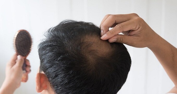 چطور از موخوره پیشگیری کنیم؟ | راز موهای درخشنده و با طراوت با این چند روش ساده