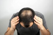 درمان های طبیعی چقدر جلوی ریزش مو را می گیرند؟