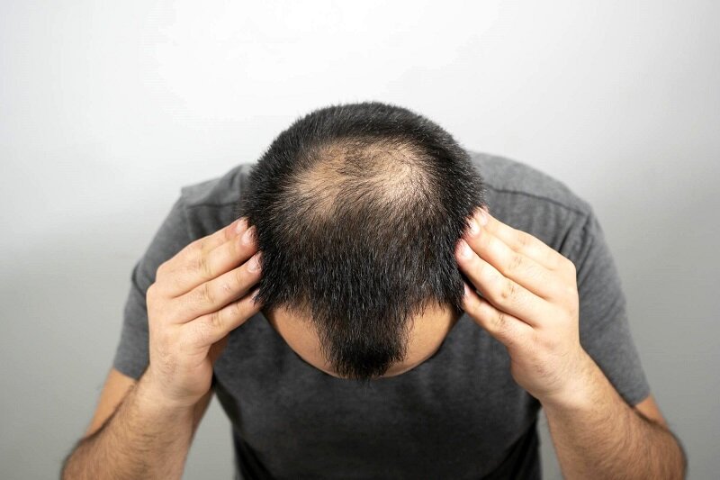 تفاوت ریزش مو در زنان و مردان | ۳ نکته در ریزش موی مردان
