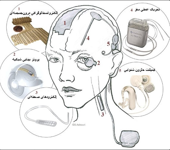 آشنایی با ایمپلنتهای مغزی یا وسایل کاشتنی مغزی