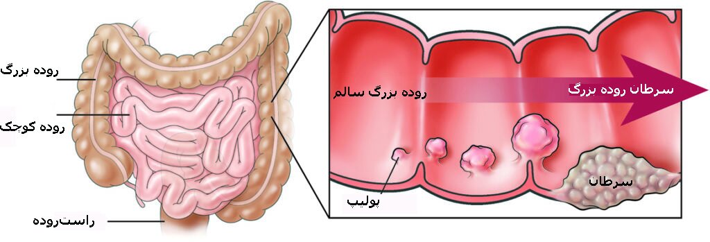 تأیید یک آزمایش خون برای تشخیص زودرس سرطان روده بزرگ