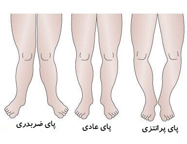 نحوه تشخیص پای پرانتزی در کودکان ؛ علل شایع پرانتزی شدن زانو را بشناسید | شکل پای پرانتزی در کودکان چگونه است؟
