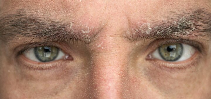 علت شوره ابرو چیست و چطور درمان میشود؟