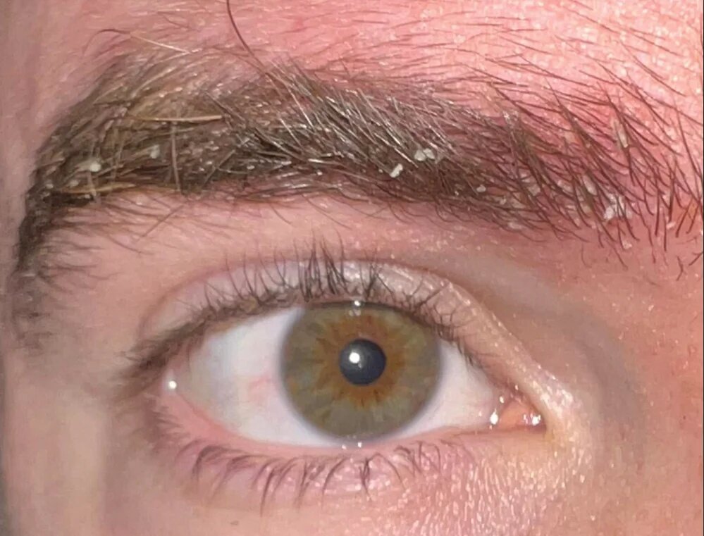 علت شوره ابرو چیست و چطور درمان میشود؟