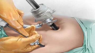 مرگ وحشتناک زن جوان در جراحی اسلیو معده | او قصد داشت لاغر شود