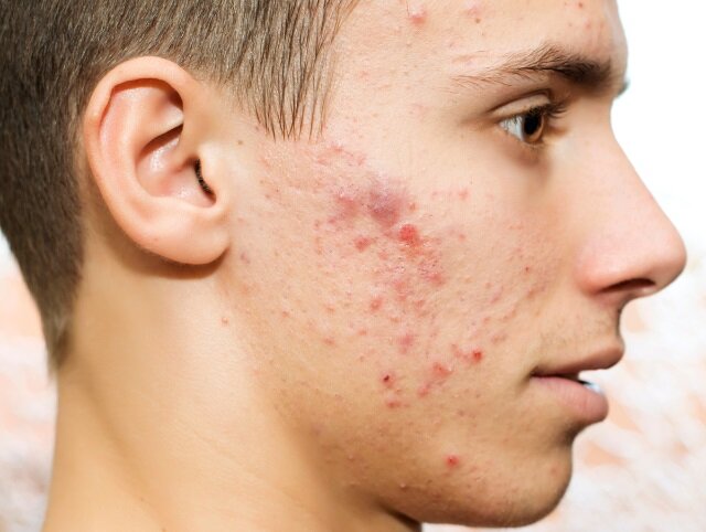 نکاتی که باید درباره جوشهای صورت بدانید | این جوش ها را فشار ندهید