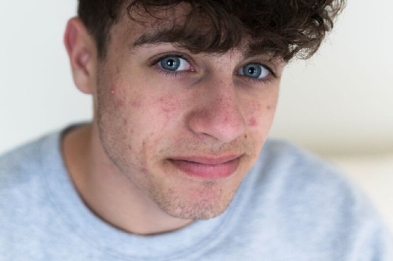 نکاتی که باید درباره جوشهای صورت بدانید | این جوش ها را فشار ندهید