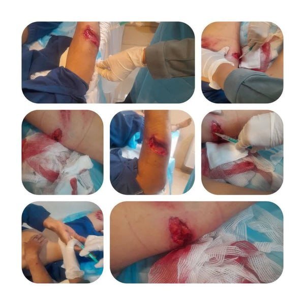 حملۀ خرس به مرد روستایی در سمیرم + عکس | زخمهای مرد روستایی را ببینید