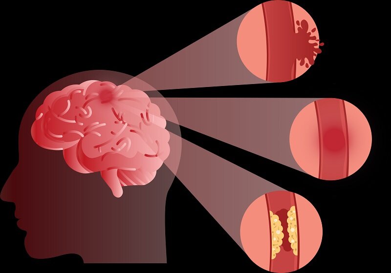 راههای پیشگیری از سکته مغزی