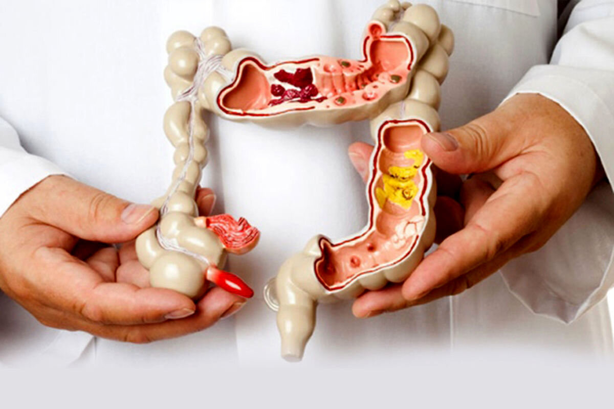 پیشگیری از سرطان روده با این دو سپر دفاعی