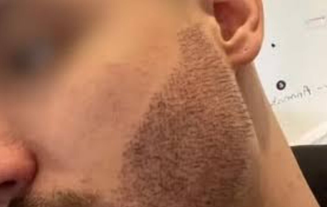 خودکشی برای بد شدن کاشت ریش 2 خودکشی برای بد شدن کاشت ریش| این پسر فرانسوی تا استانبول رفته بود| عکس