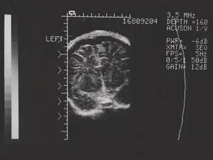 تصاویر دیدنی از اولین دستگاه های سونوگرافی | کشف سونوگرافی اولین بار در جنگ جهانی اول