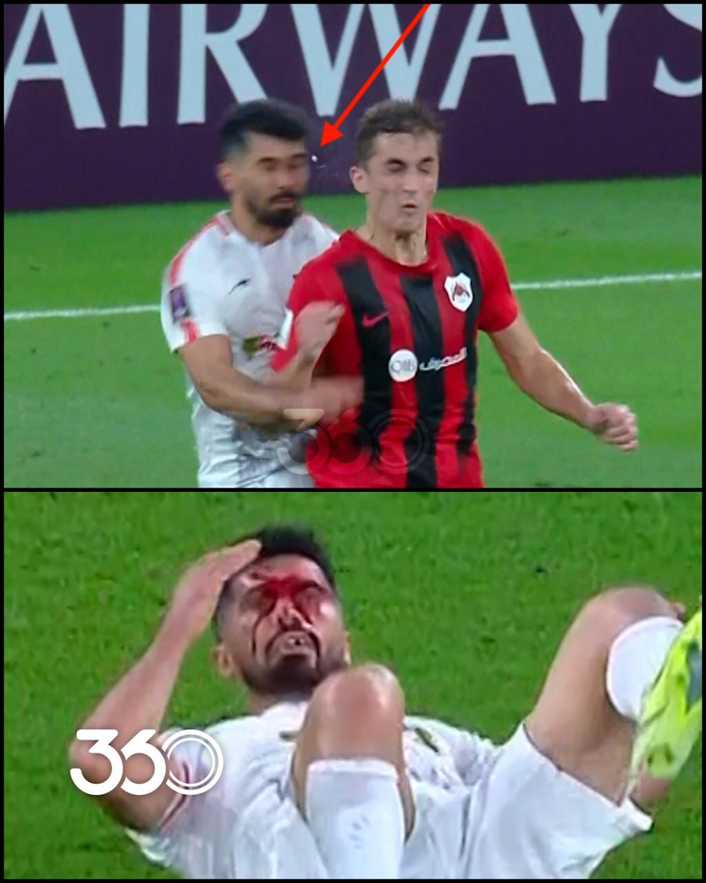 دلش را ندارید نبینید | واضحترین تصویر از مصدومیت شدید امید عالیشاه | لحظه کنده شدن دندان کاپیتان