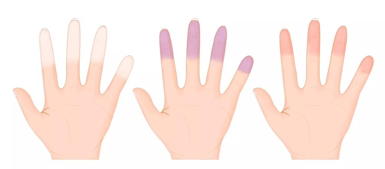 یخزدگی انگشتهای دست و پا میتواند علت یک بیماری خطرناک باشد؟