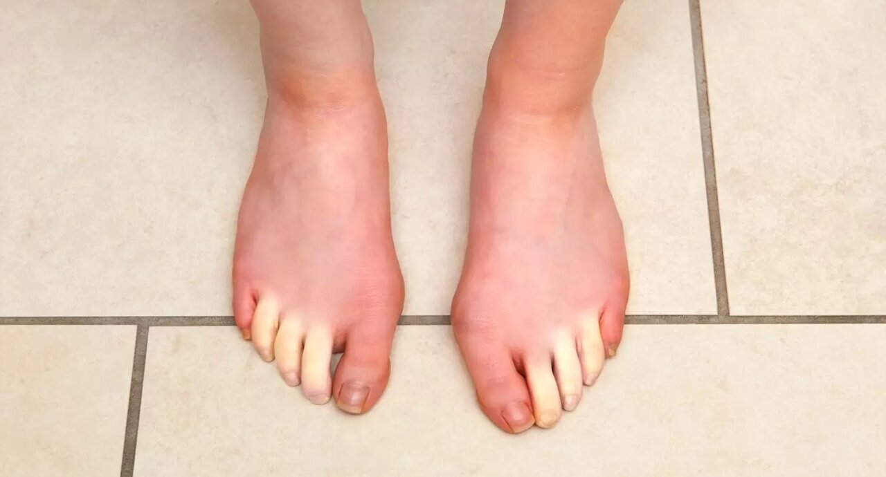 یخزدگی انگشتهای دست و پا میتواند علت یک بیماری خطرناک باشد؟