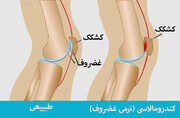 درباره نرمی کشکک زانو