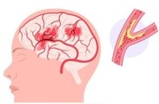 اختلال گذرای خون‌رسانی مغز