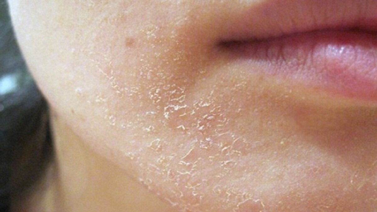 علت زبری و پوسته پوسته شدن پوست ؛ چطور میتوان از آن پیشگیری کرد؟