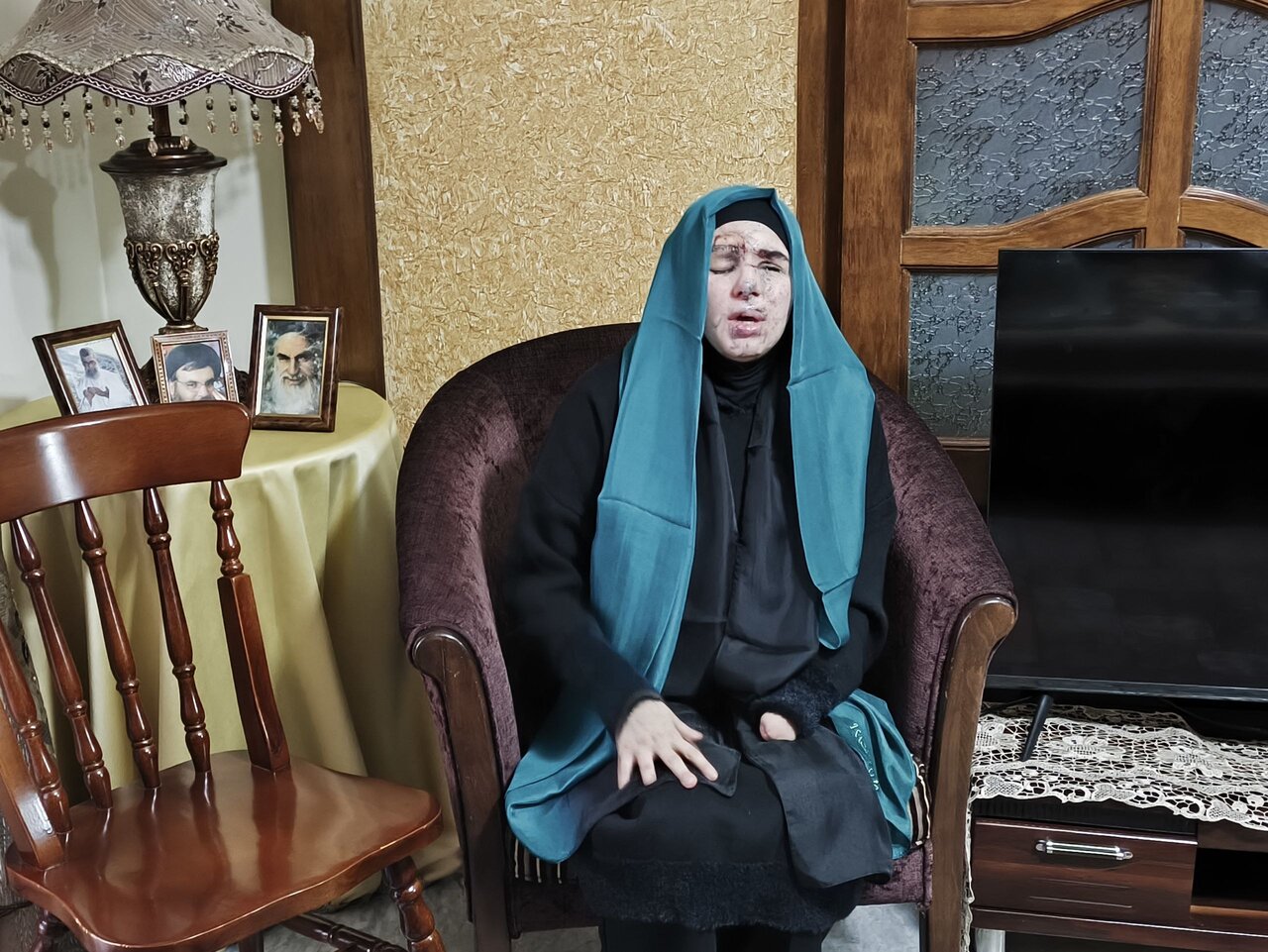 جانباز زن حادثه تروریستی پیجرها؛ تصویر قبل و بعد روان الموسوی را ببینید | تصاویر