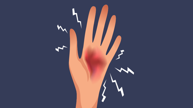 چرا بدون ضربه دچار کبودی میشویم؟ بررسی علل و راهکارهای درمان