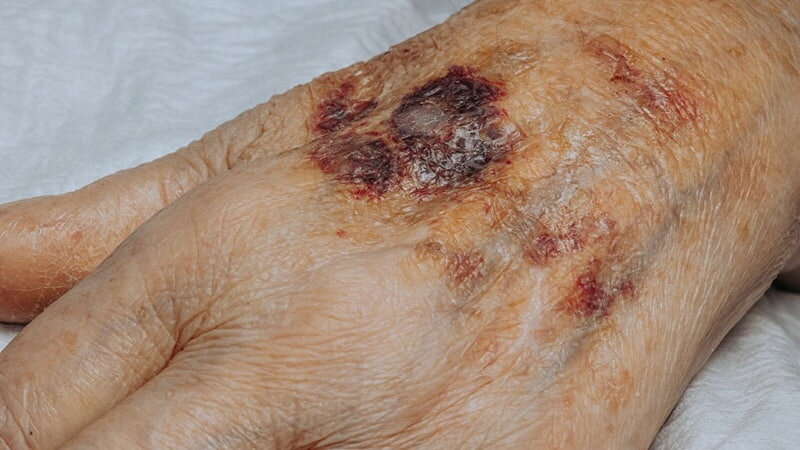 چرا بدون ضربه دچار کبودی میشویم؟ بررسی علل و راهکارهای درمان