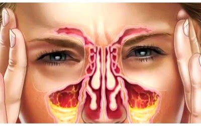 رنگ مخاط نشانه چه بیماری هایی در بدن است؟