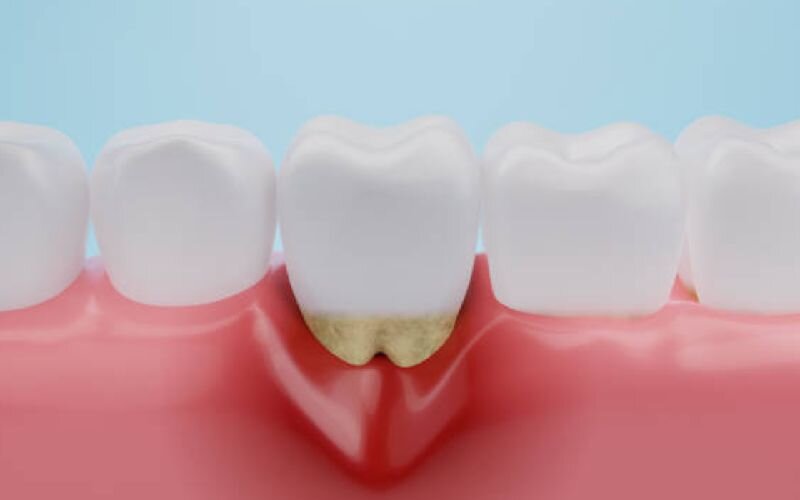 حساسیت دندان چیست؟ وقتی لیوان آب سرد به یک کابوس تبدیل میشود!