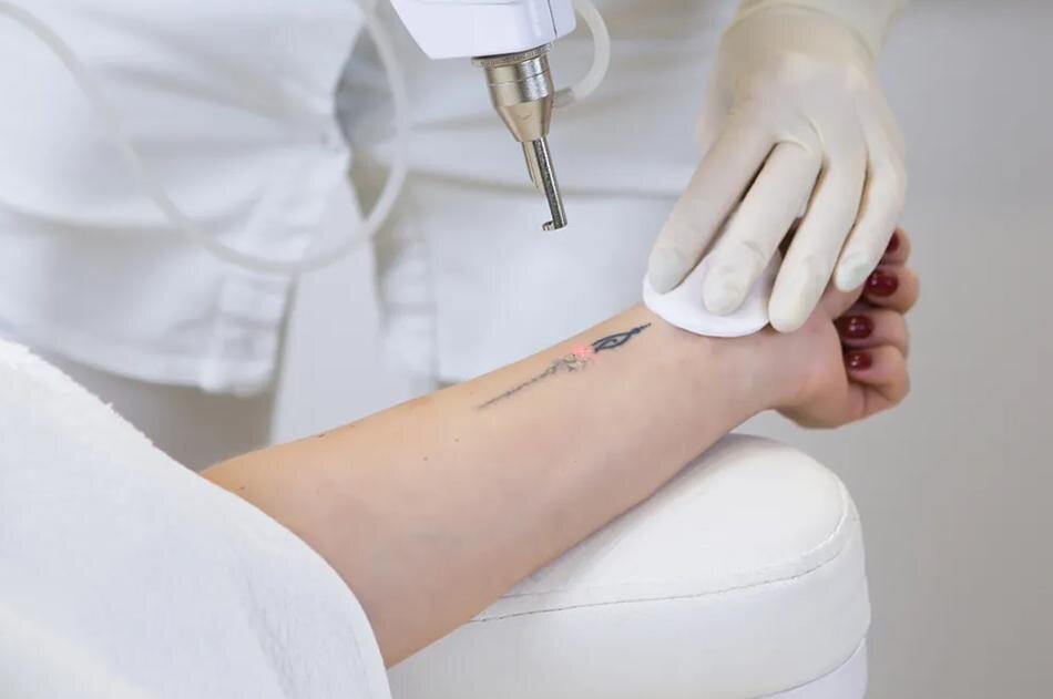 چگونه تتوی خود را بهطور کامل پاک کنیم؟