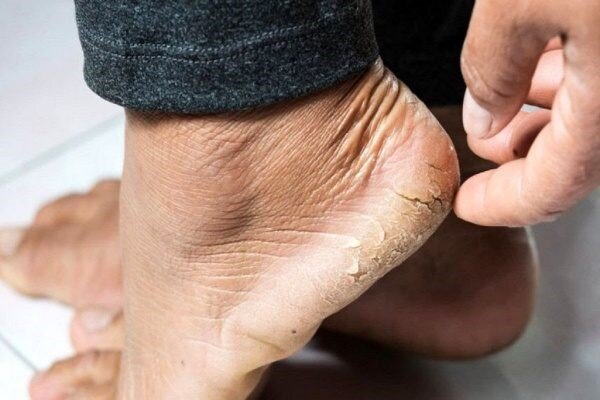 خشکی پاشنه پا را چگونه درمان کنیم؟ | شایعترین دلایل خشکی پاشنه پا