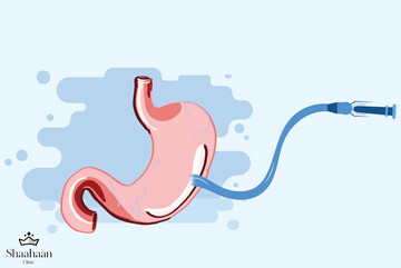 بوتاکس معده راهی نوین و غیرتهاجمی برای کاهش وزن| هزینه بوتاکس معده