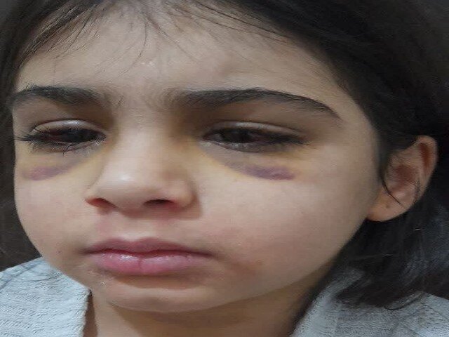 ضرب و شتم هولناک دختربچه ۹ ساله توسط نامادری+ عکس | ارجاع پرونده کودکآزاری به دادگستری