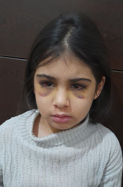 ضرب و شتم هولناک دختربچه ۹ ساله توسط نامادری+ عکس | ارجاع پرونده کودکآزاری به دادگستری