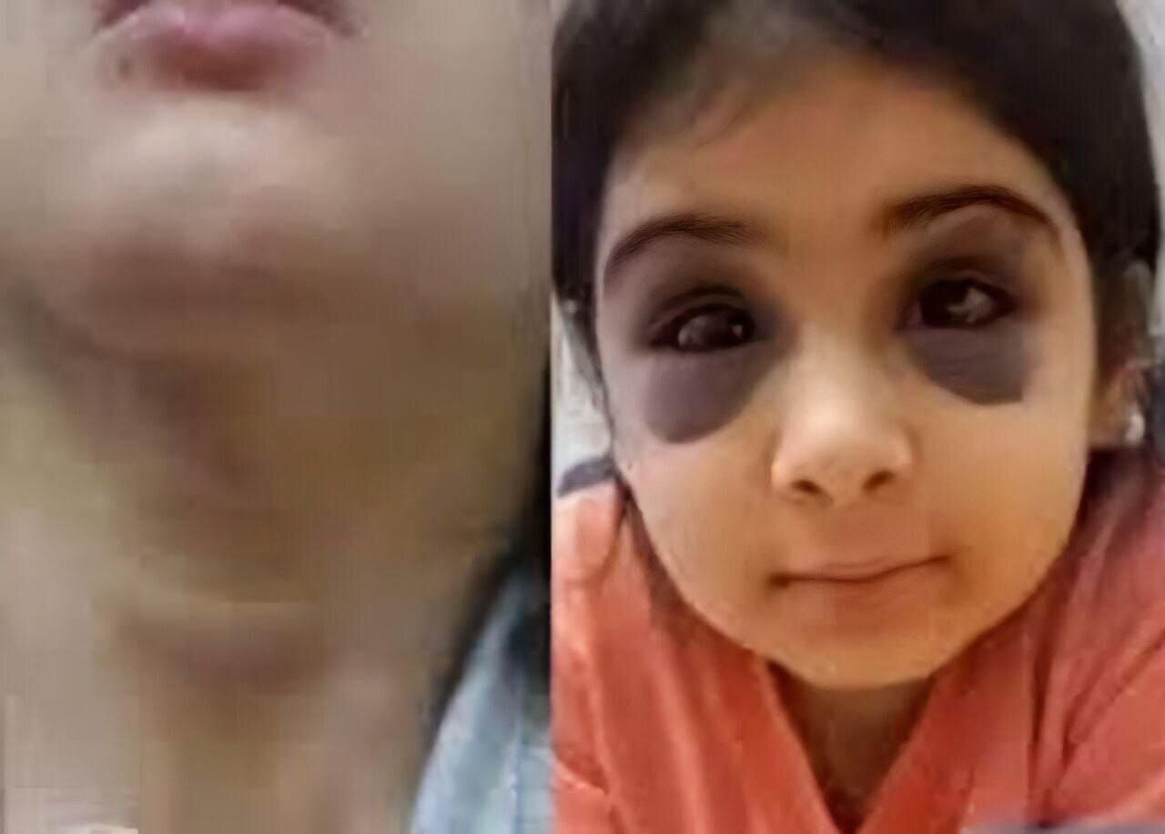 ضرب و شتم هولناک دختربچه ۹ ساله توسط نامادری+ عکس | ارجاع پرونده کودکآزاری به دادگستری