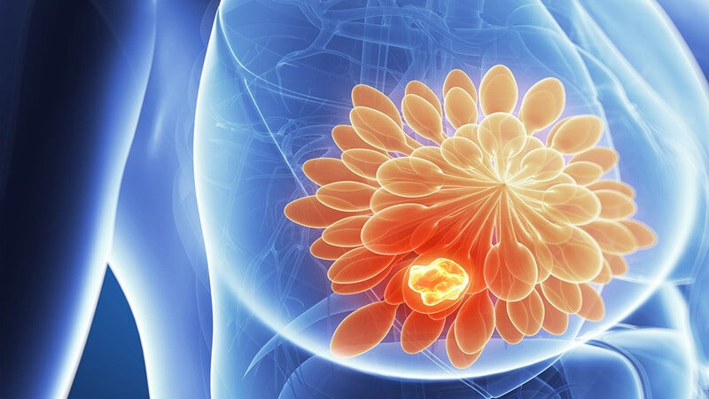 روشهای پیشگیری از سرطان سینه