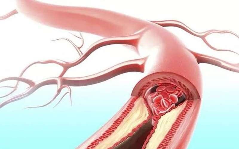 نشانه‌های مسدود شدن رگ قلب