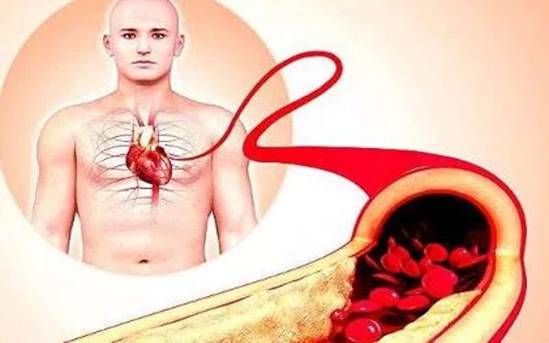 نشانههای مسدود شدن رگ قلب