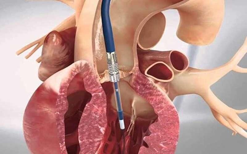 نشانههای مسدود شدن رگ قلب