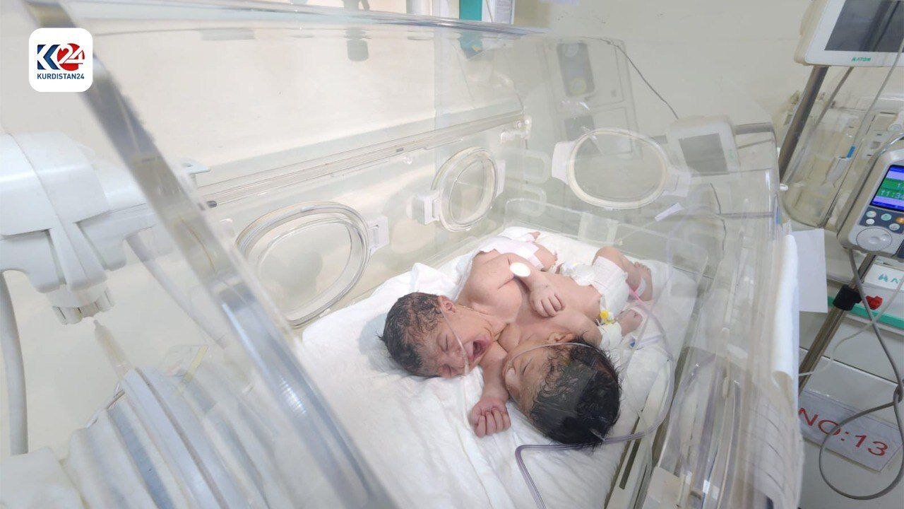 تولد دو کودک بهم چسبیده با قلب مشترک | عکس