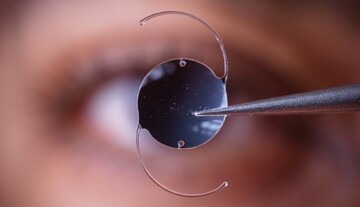 سبک زندگی نادرست، سن ابتلا به آب‌مروارید را پایین آورد | این بیماری با قطره و عینک درمان نمی‌شود