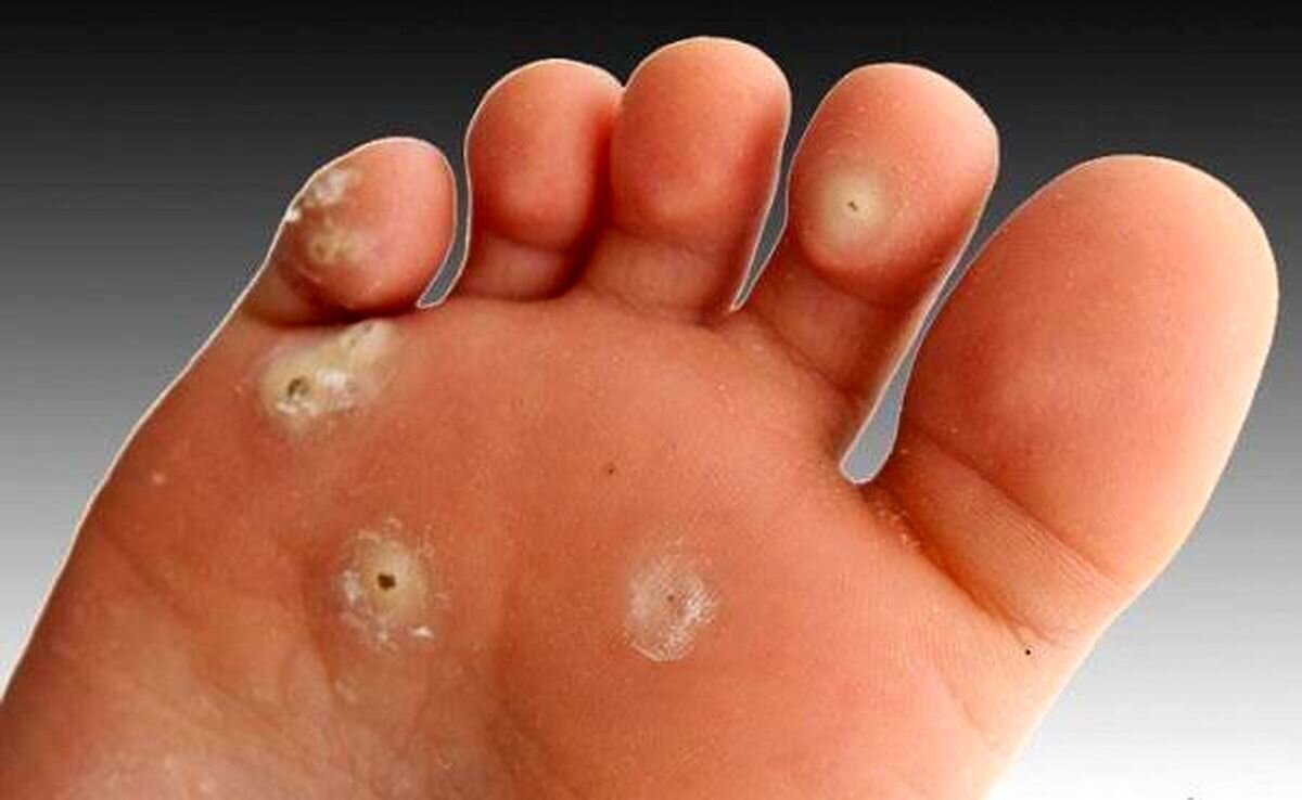 میخچه پا چیست و چگونه درمان میشود؟ + عکس میخچه پا