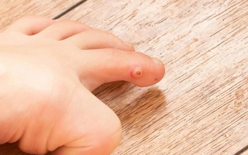 میخچه پا چیست و چگونه درمان میشود؟ + عکس میخچه پا