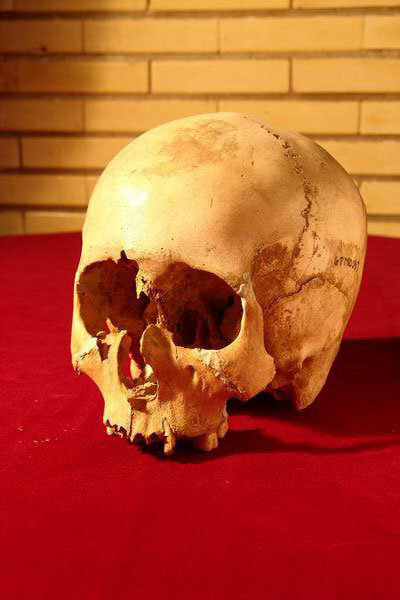 نخستین جراحی موفق مغز به چه زمانی برمیگردد؟ | سوراخ کردن مغز برای خروج ارواح خبیث!