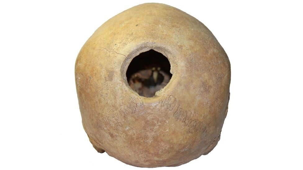 نخستین جراحی موفق مغز به چه زمانی برمیگردد؟ | سوراخ کردن مغز برای خروج ارواح خبیث!