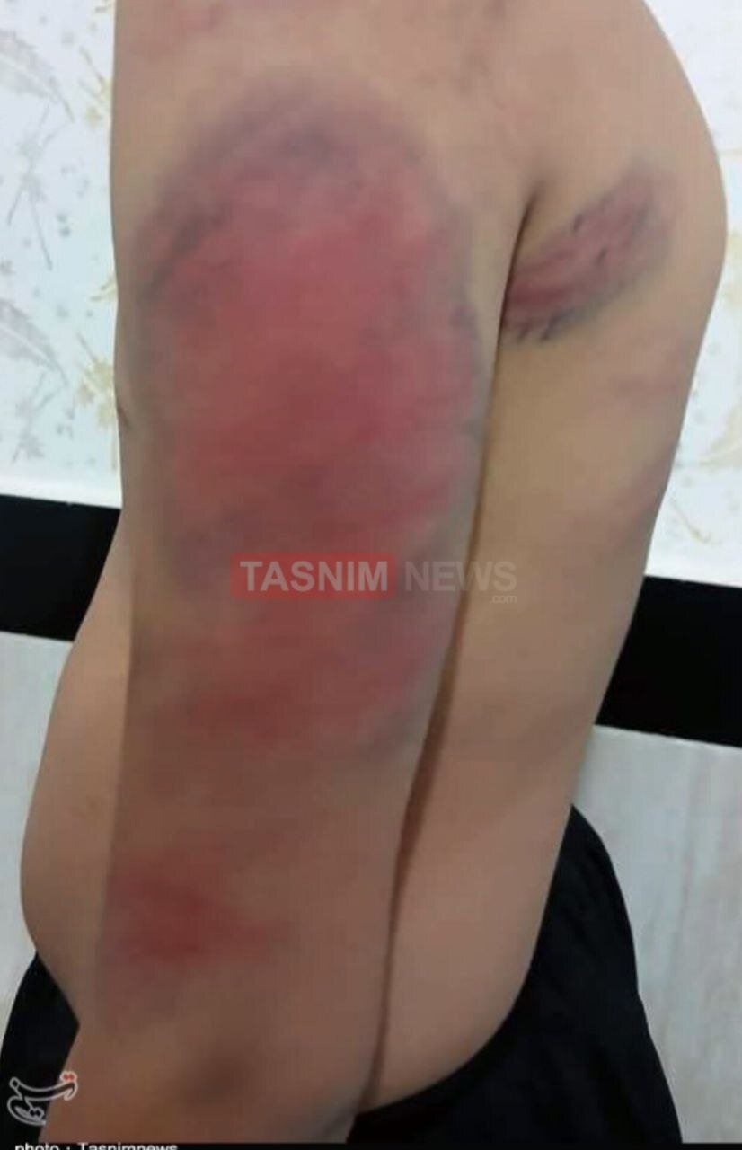 ضرب و شتم شدید دانشآموزان دبستانی توسط معلمشان + تصاویر | بستری شدن یک دانشآموز در بیمارستان | معلم خاطی فارغالتحصیل دانشگاه فرهنگیان است