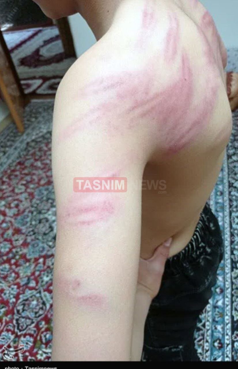 ضرب‌ و شتم شدید دانش‌آموزان دبستانی توسط معلمشان + تصاویر | بستری شدن یک دانش‌آموز در بیمارستان | معلم خاطی فارغ‌التحصیل دانشگاه فرهنگیان است