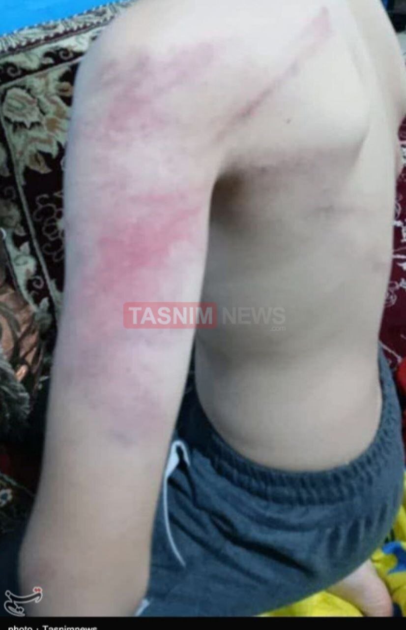 ضرب و شتم شدید دانشآموزان دبستانی توسط معلمشان + تصاویر | بستری شدن یک دانشآموز در بیمارستان | معلم خاطی فارغالتحصیل دانشگاه فرهنگیان است