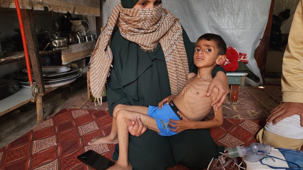 سوءتغذیه،کودکان مظلوم فلسطینی،جنایات هولناک اسرائیل،نسل کشی