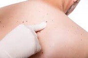 کدام رنگ خال ها سرطانی هستند؟